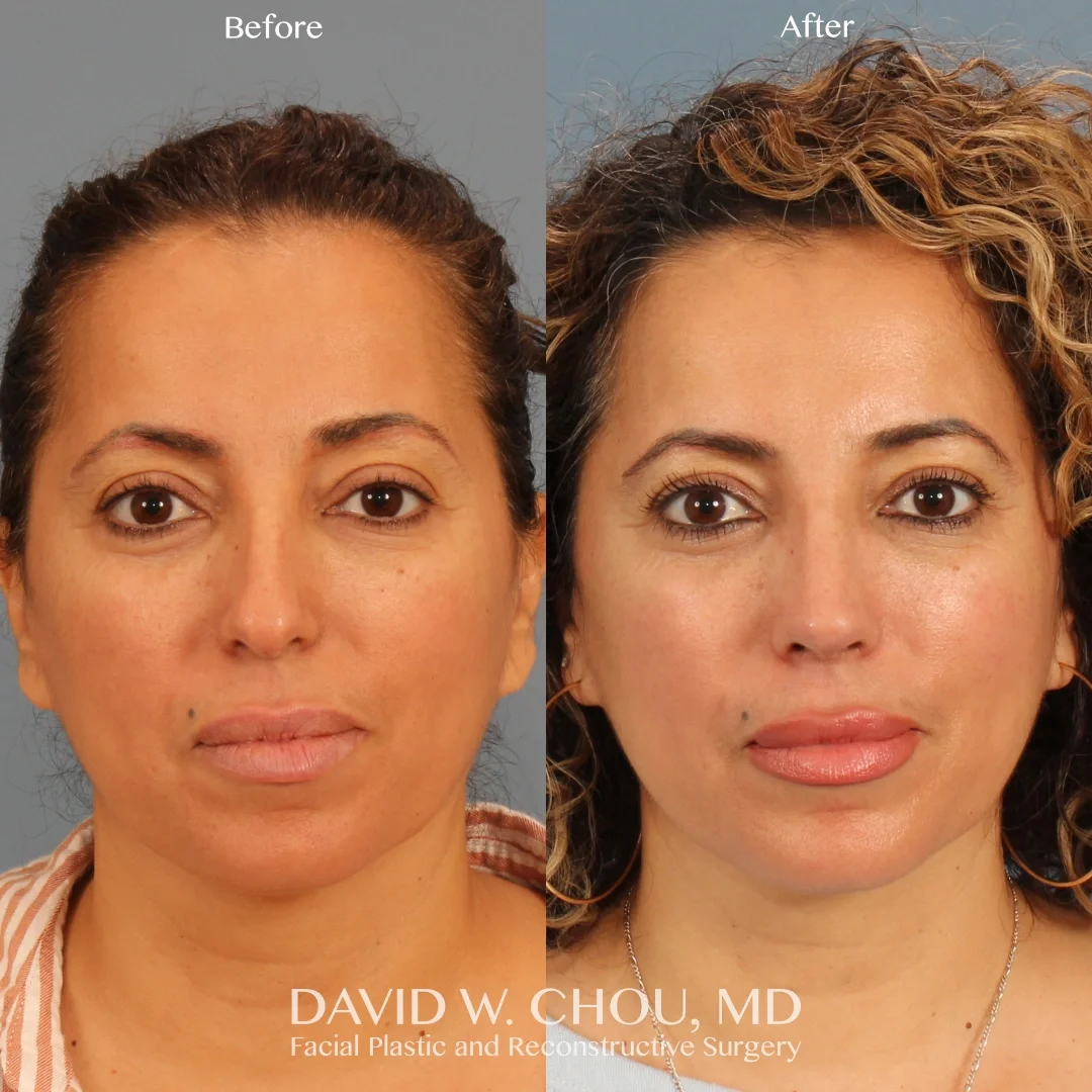 Real patient in Berkeley, CA Performed by Dr David Chou MD