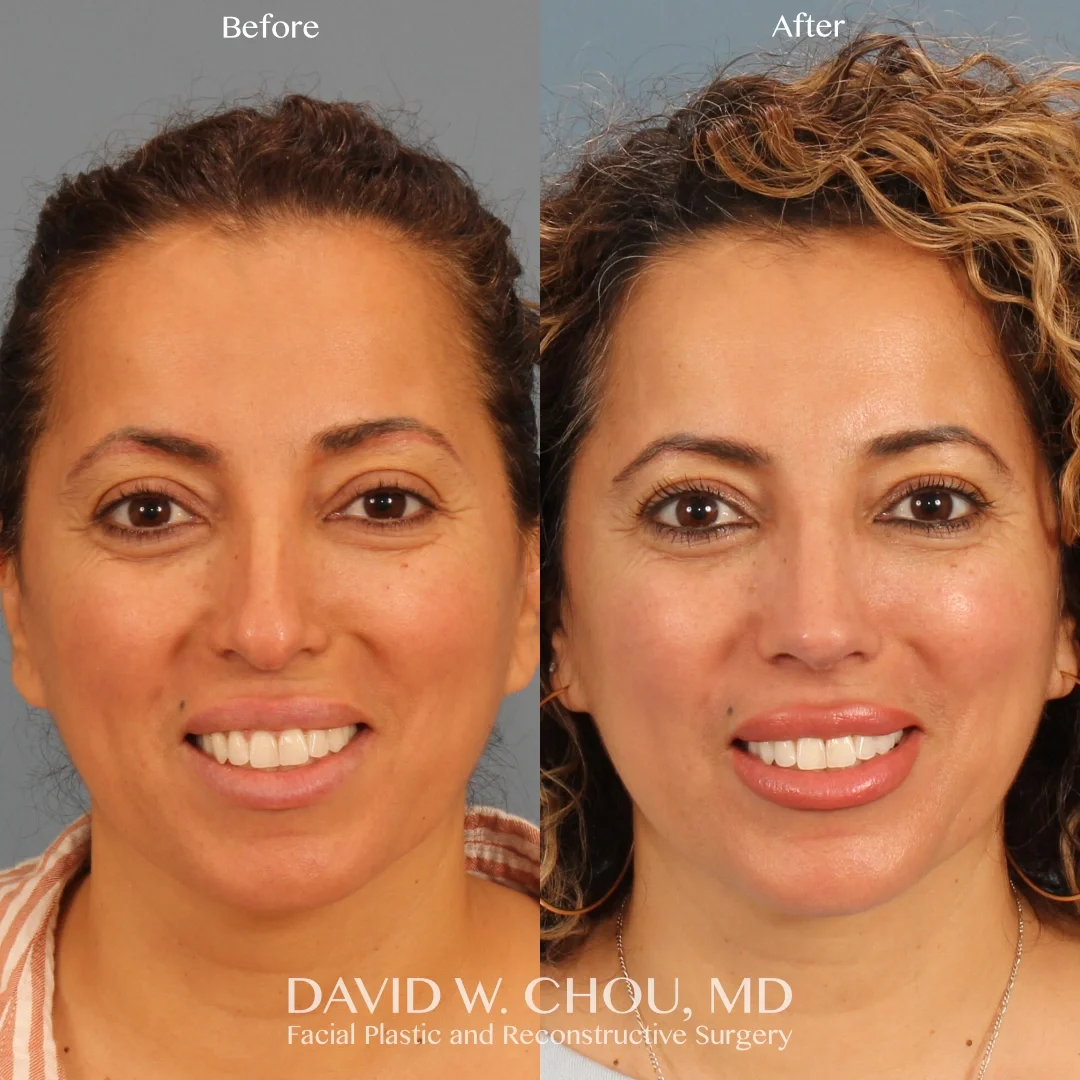 Real patient in Berkeley, CA Performed by Dr David Chou MD