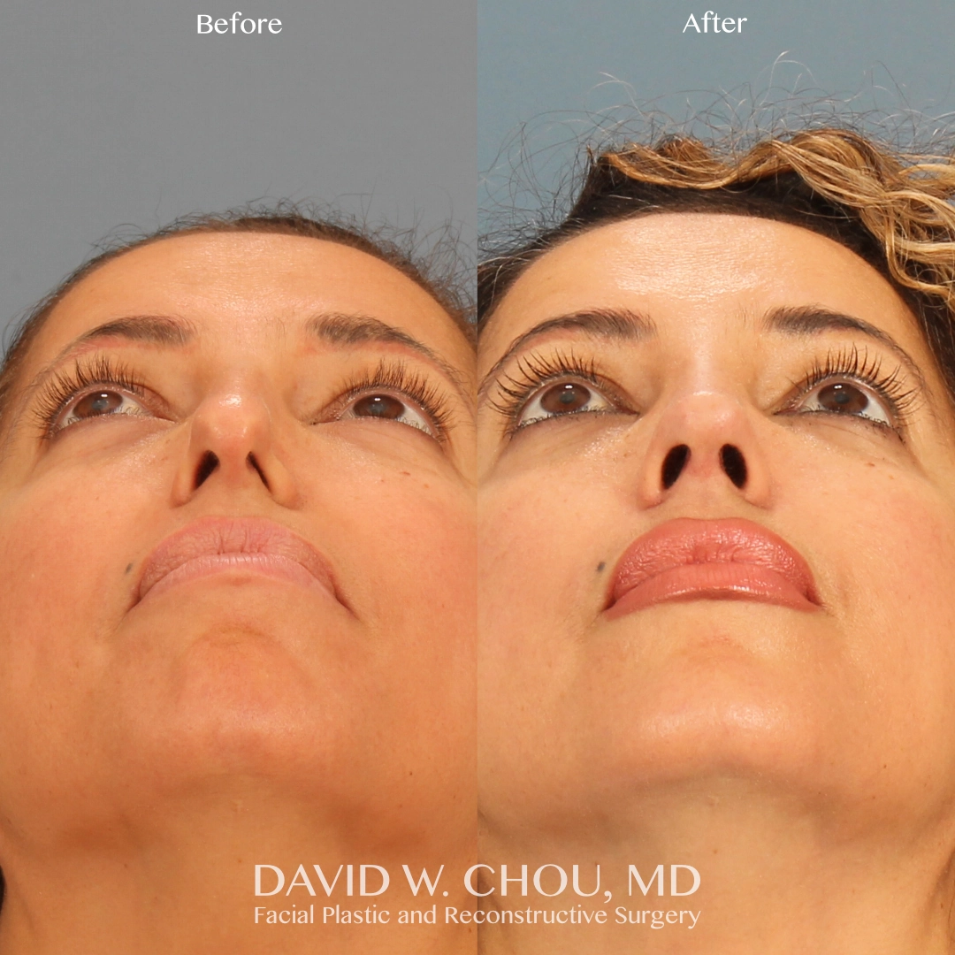 Real patient in Berkeley, CA Performed by Dr David Chou MD