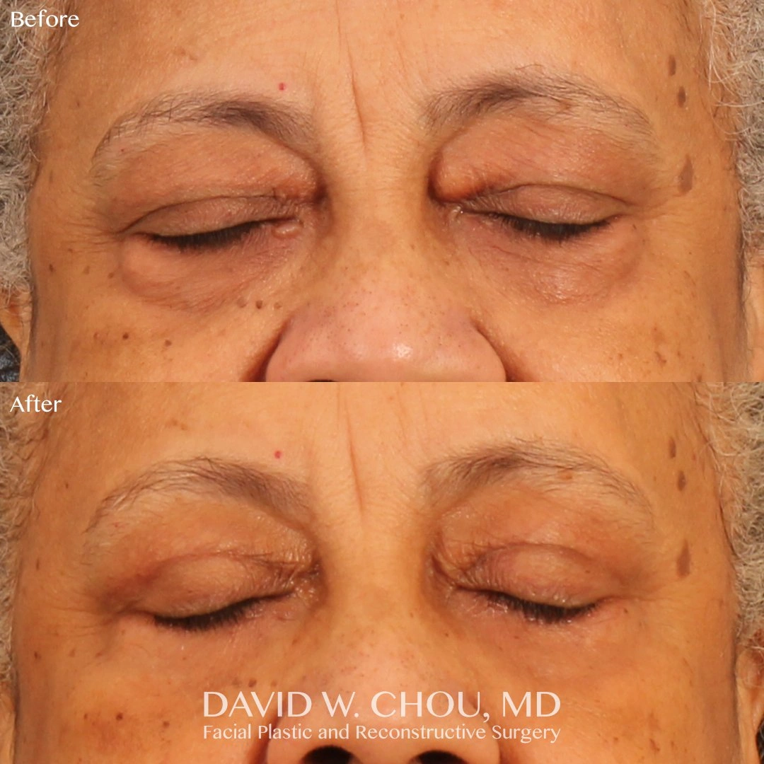 5+weeks+postop+quad+bleph+eyes+closed