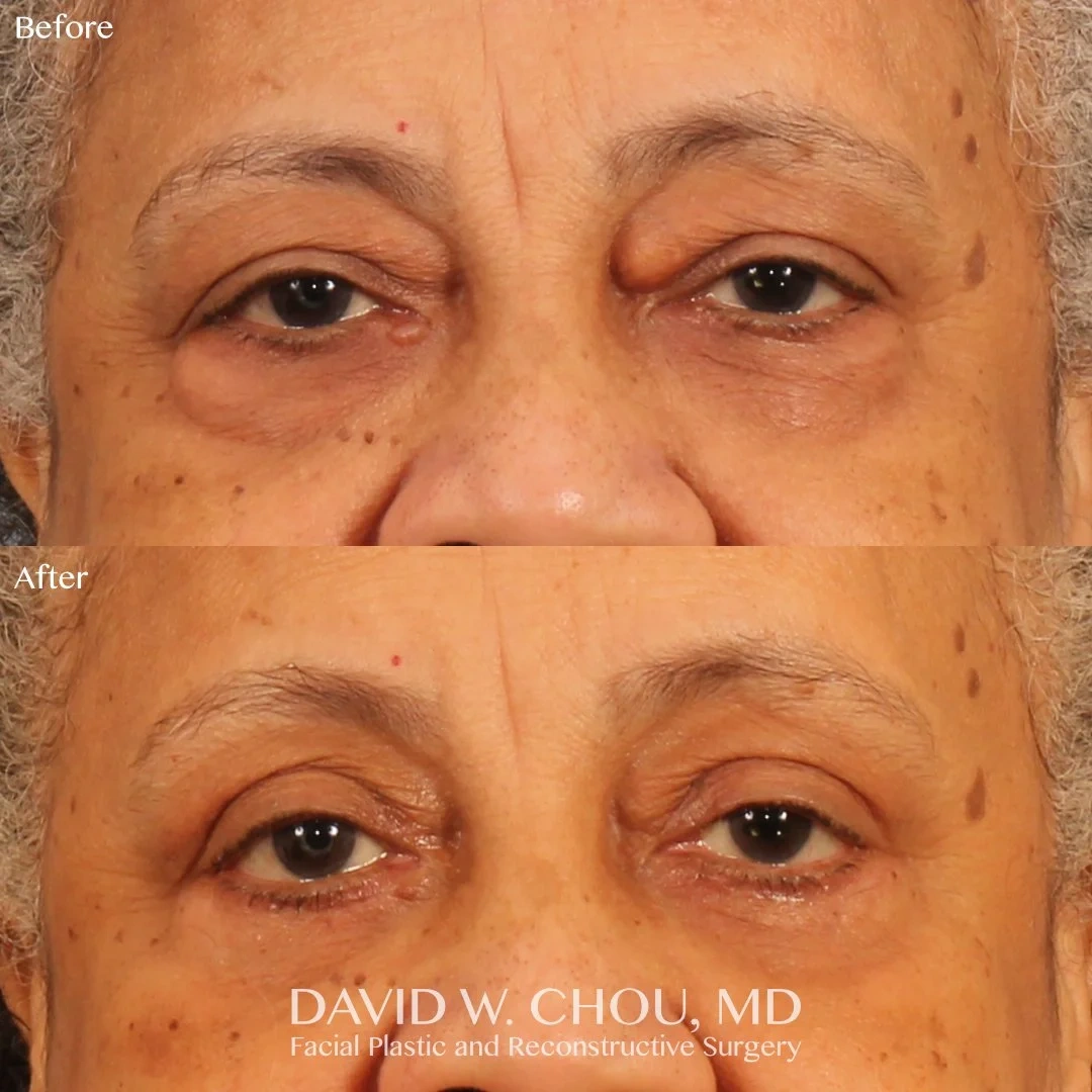 before+after+top+bottom+eyes+quad+bleph+skin+pinch