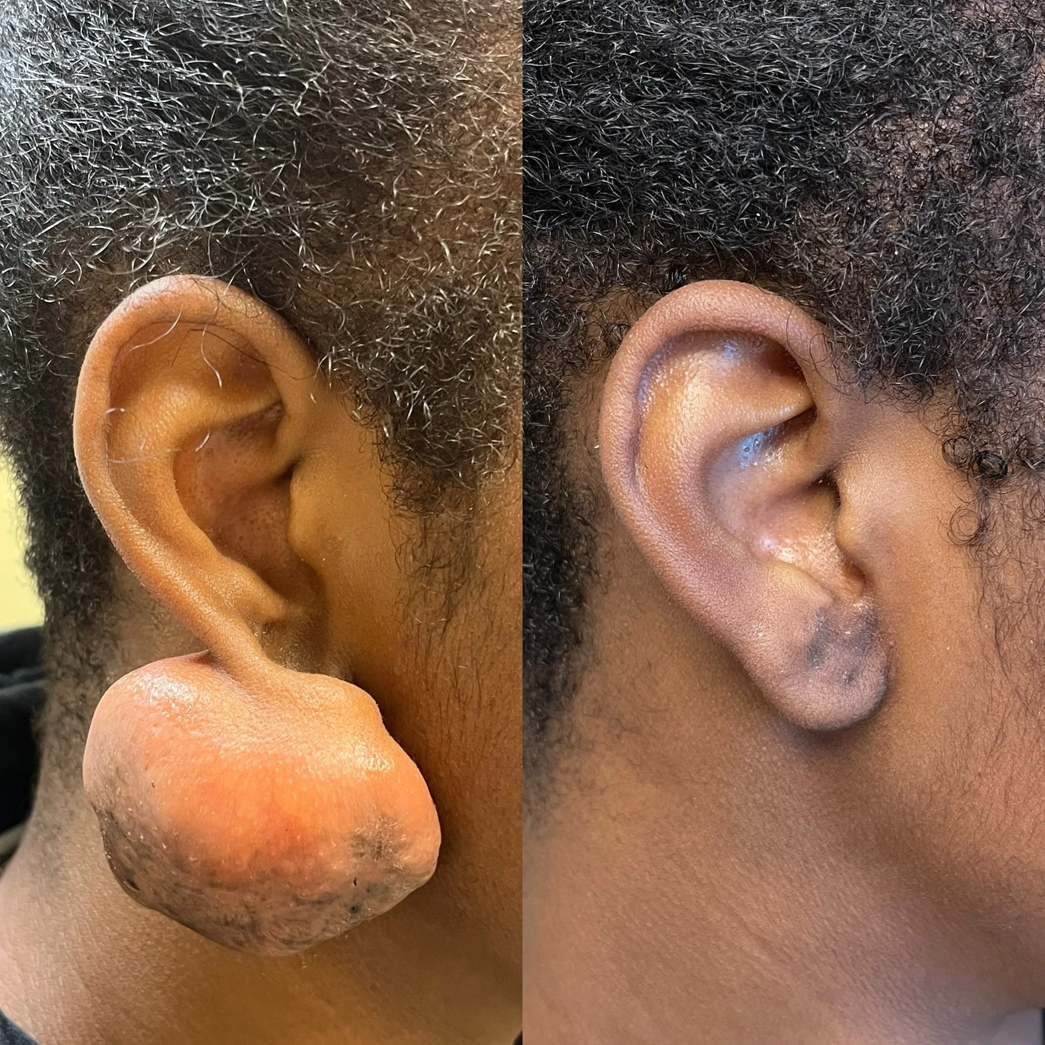 ear+keloid