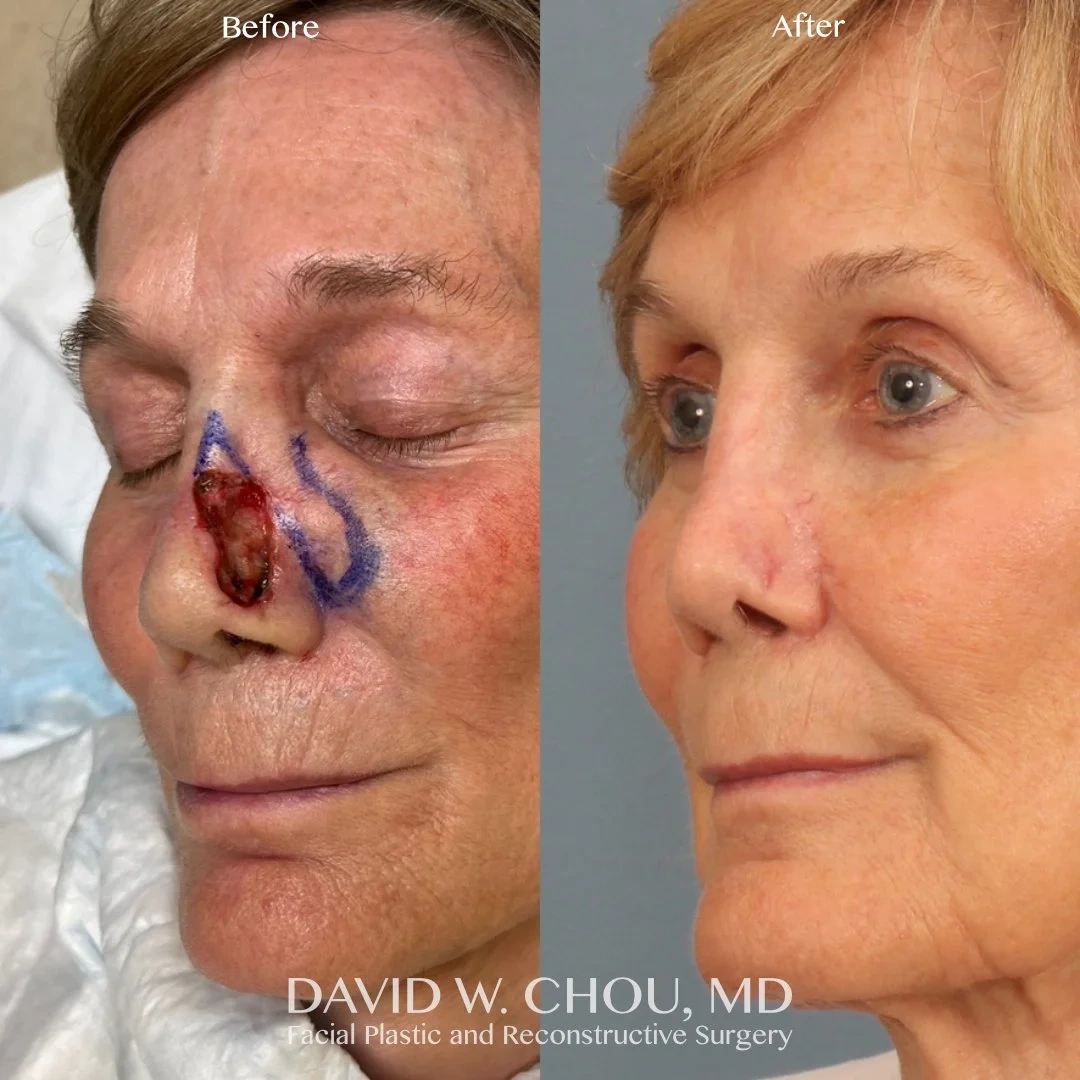 left+nasal+mohs+recon+before+after