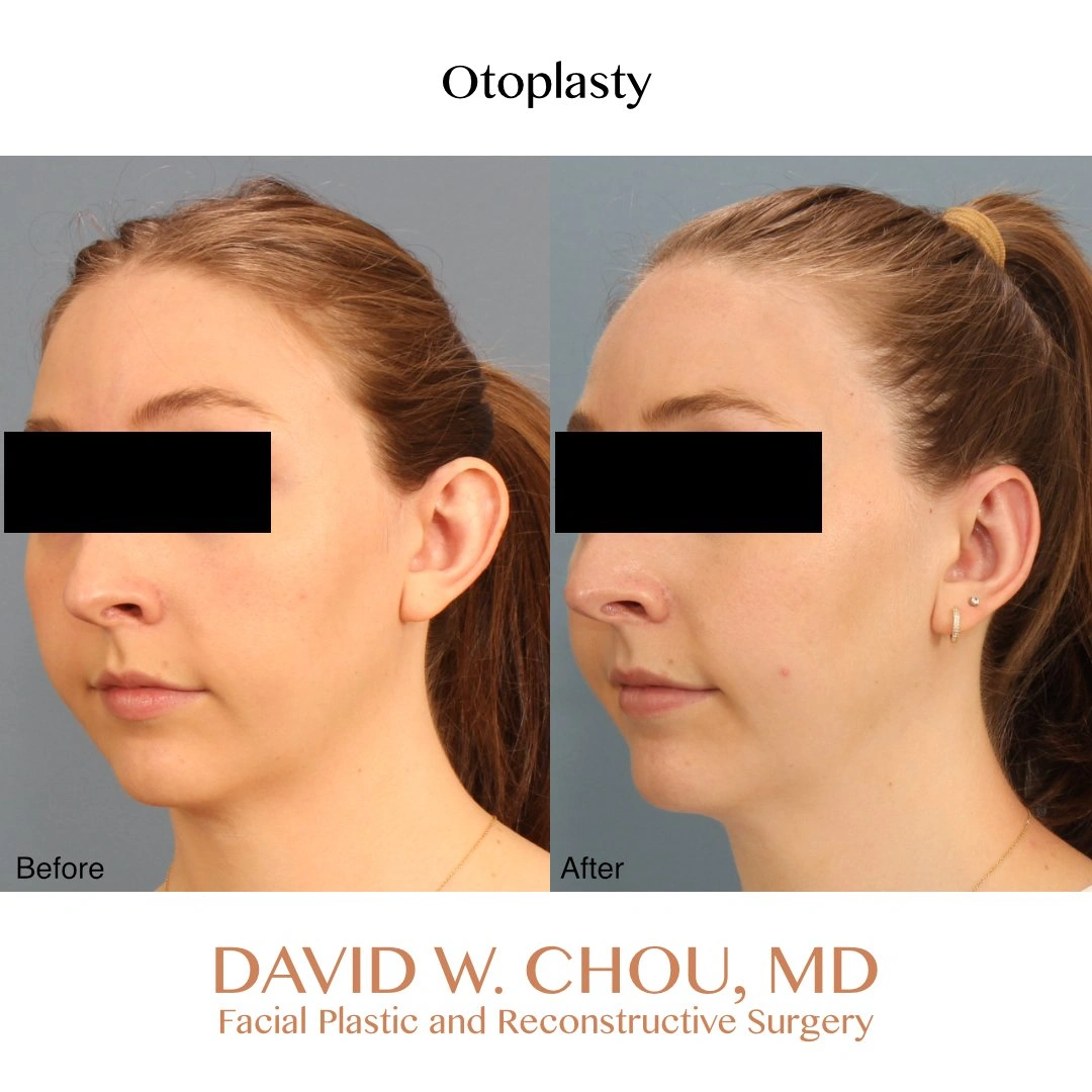 left+oblique+before+after