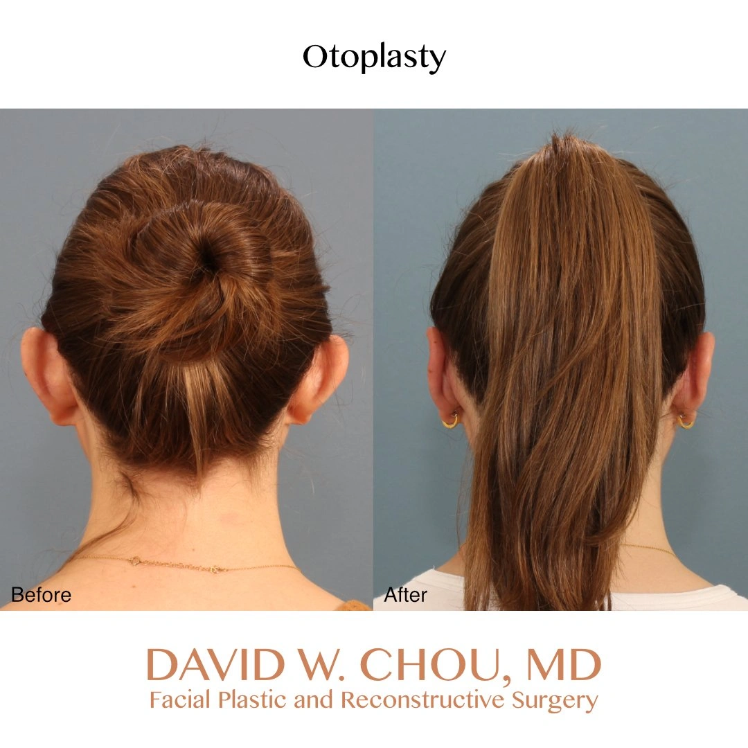 posterior+before+after