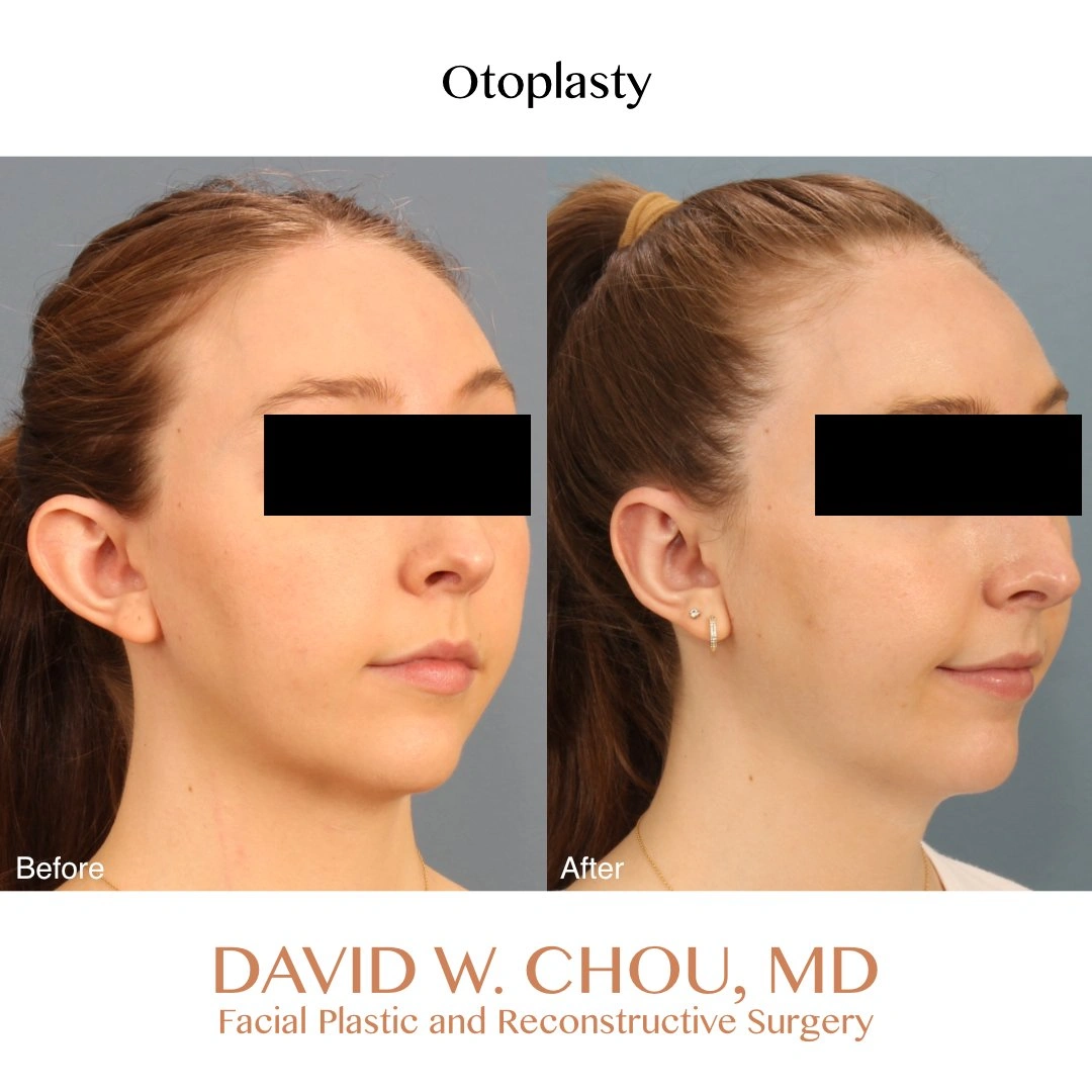 right+oblique+before+after
