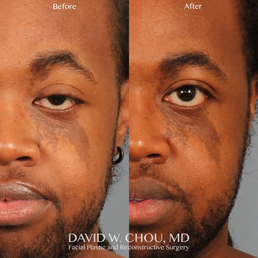 side+by+side+13+mo+postop+ptosis+repair