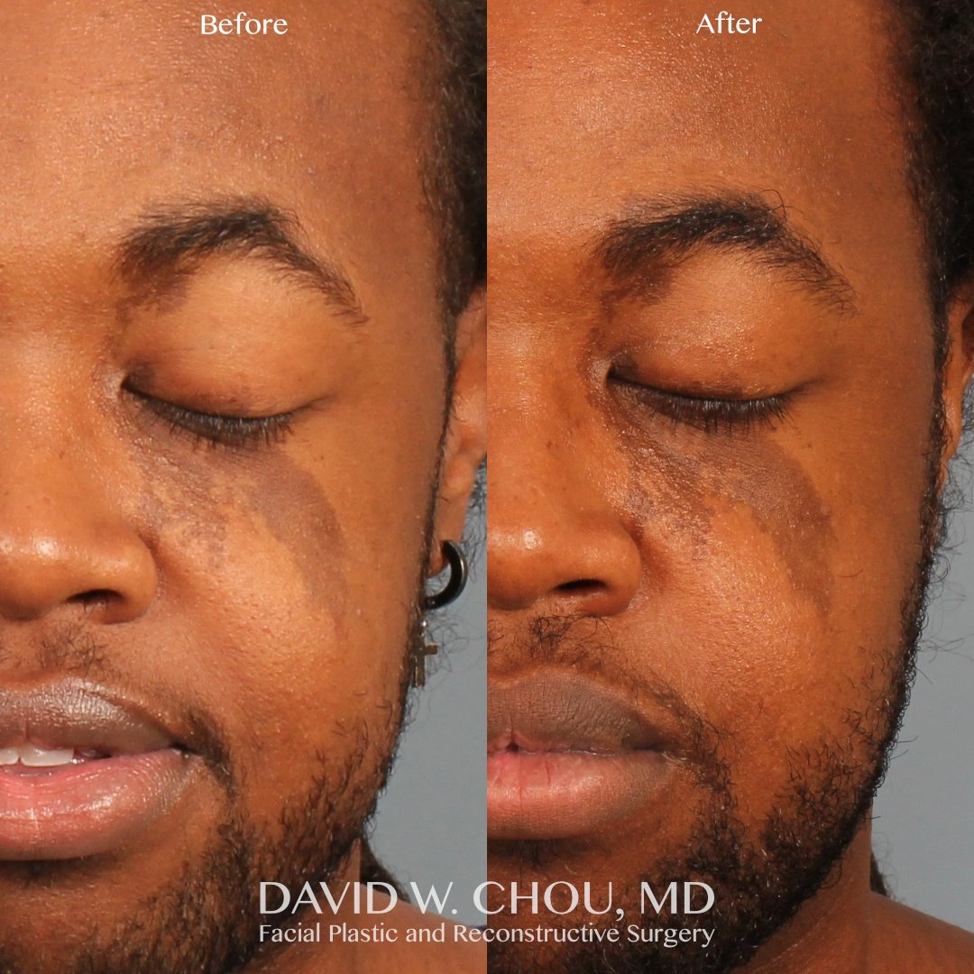 side+by+side+13+mo+postop+ptosis+repair+eyes+closed